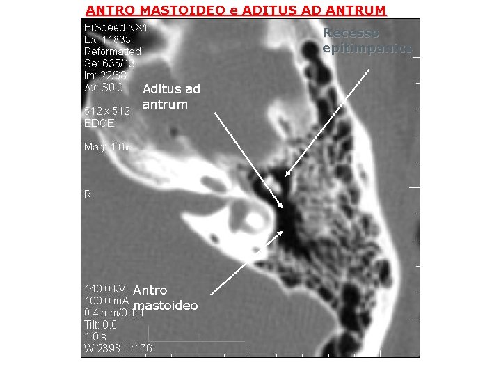 ANTRO MASTOIDEO e ADITUS AD ANTRUM Recesso epitimpanico Aditus ad antrum Antro mastoideo 