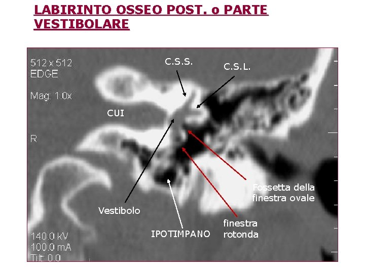 LABIRINTO OSSEO POST. o PARTE VESTIBOLARE C. S. S. C. S. L. CUI Fossetta