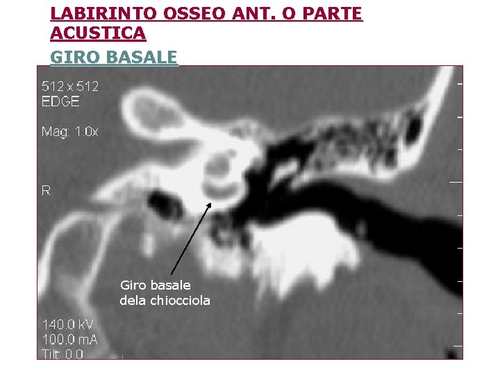 LABIRINTO OSSEO ANT. O PARTE ACUSTICA GIRO BASALE Giro basale dela chiocciola 