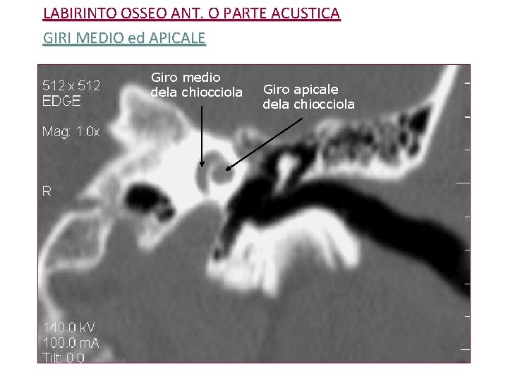 LABIRINTO OSSEO ANT. O PARTE ACUSTICA GIRI MEDIO ed APICALE Giro medio dela chiocciola