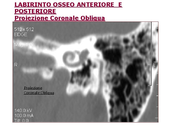 LABIRINTO OSSEO ANTERIORE E POSTERIORE Proiezione Coronale Obliqua 
