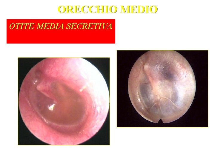 ORECCHIO MEDIO OTITE MEDIA SECRETIVA 