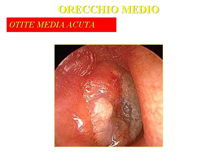 ORECCHIO MEDIO OTITE MEDIA ACUTA 