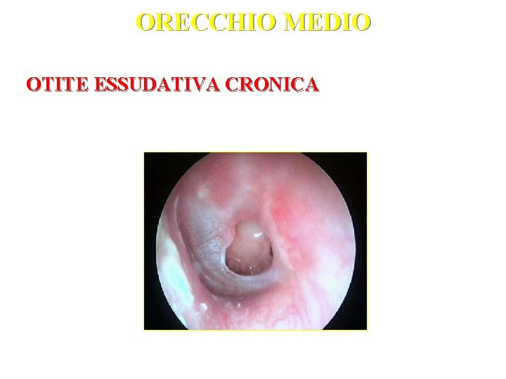 ORECCHIO MEDIO OTITE ESSUDATIVA CRONICA 