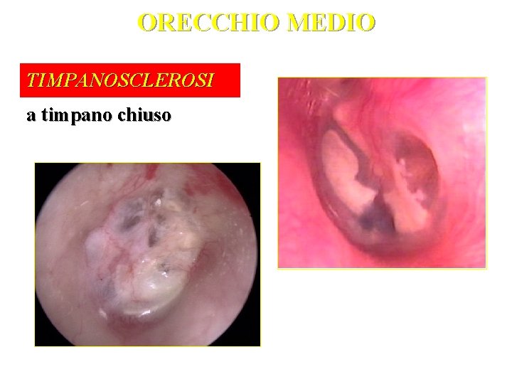 ORECCHIO MEDIO TIMPANOSCLEROSI a timpano chiuso 