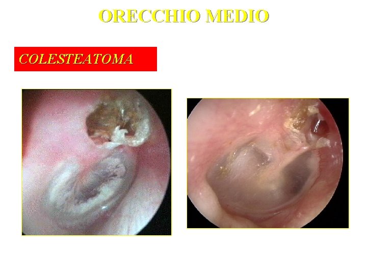 ORECCHIO MEDIO COLESTEATOMA 