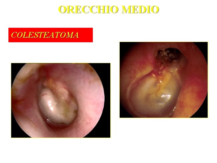 ORECCHIO MEDIO COLESTEATOMA 
