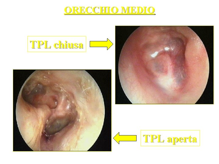 ORECCHIO MEDIO TPL chiusa TPL aperta 