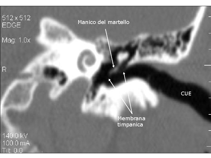 Manico del martello CUE Membrana timpanica 