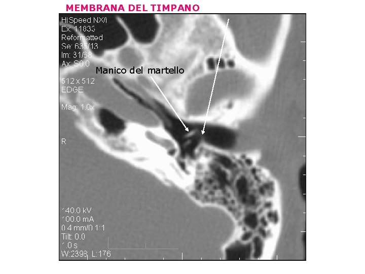 MEMBRANA DEL TIMPANO Manico del martello 