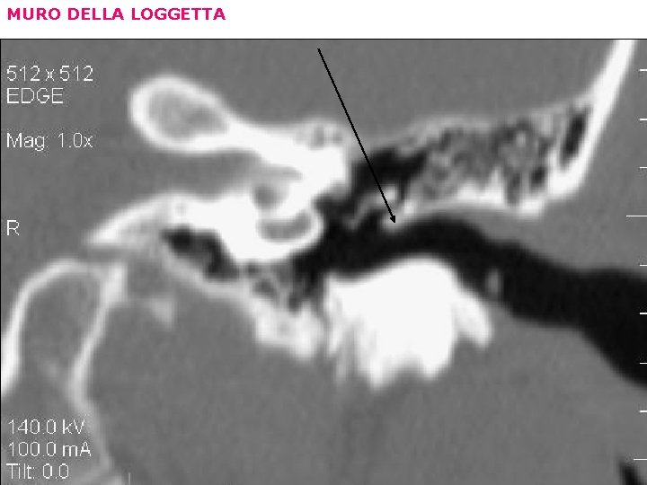 MURO DELLA LOGGETTA 
