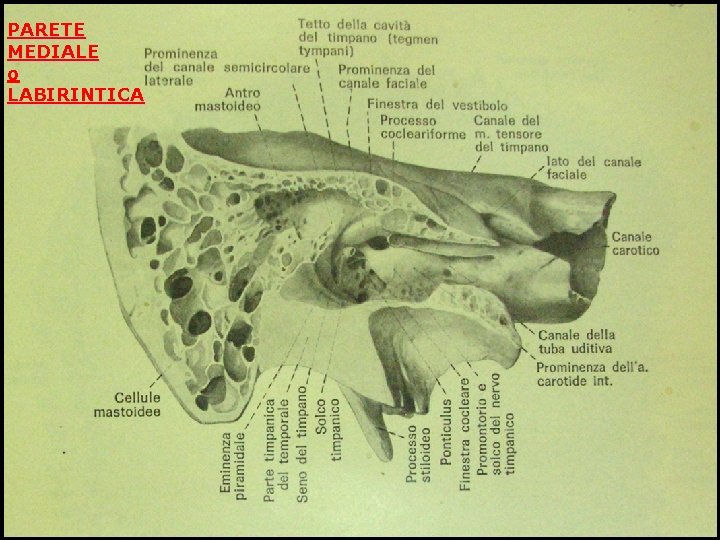 PARETE MEDIALE o LABIRINTICA 