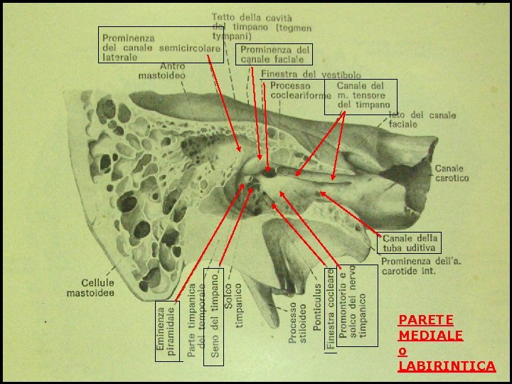 PARETE MEDIALE o LABIRINTICA 