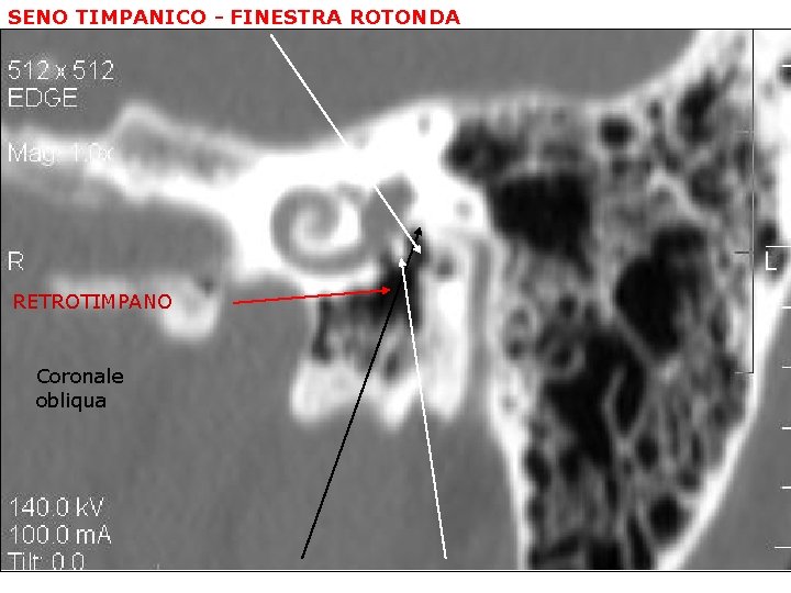 SENO TIMPANICO - FINESTRA ROTONDA RETROTIMPANO Coronale obliqua nticulus - Subiculum 