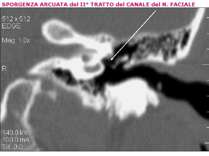 SPORGENZA ARCUATA del II° TRATTO del CANALE del N. FACIALE 