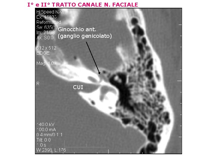 I° e II° TRATTO CANALE N. FACIALE Ginocchio ant. (ganglio genicolato) CUI 