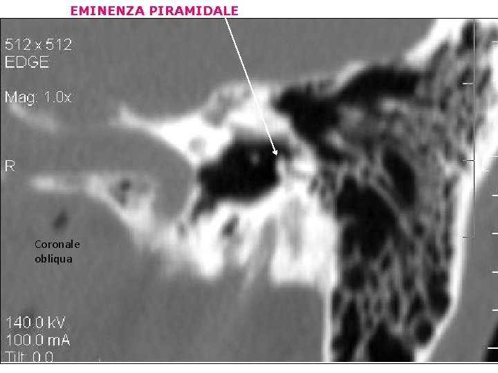 EMINENZA PIRAMIDALE Coronale obliqua 