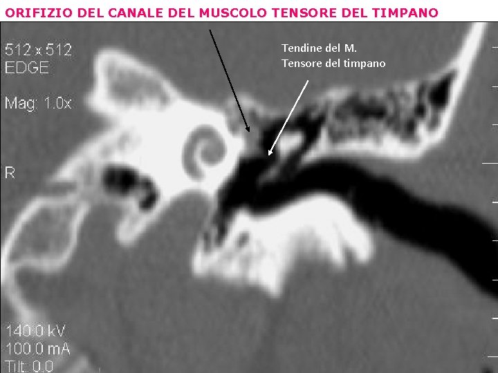 ORIFIZIO DEL CANALE DEL MUSCOLO TENSORE DEL TIMPANO Tendine del M. Tensore del timpano