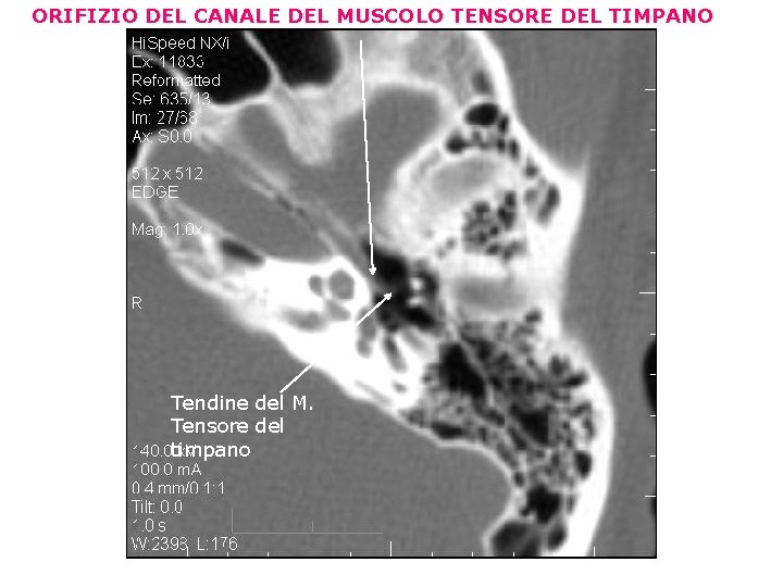 ORIFIZIO DEL CANALE DEL MUSCOLO TENSORE DEL TIMPANO Tendine del M. Tensore del timpano