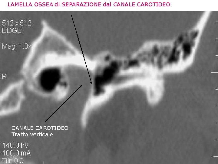 LAMELLA OSSEA di SEPARAZIONE dal CANALE CAROTIDEO Tratto verticale 