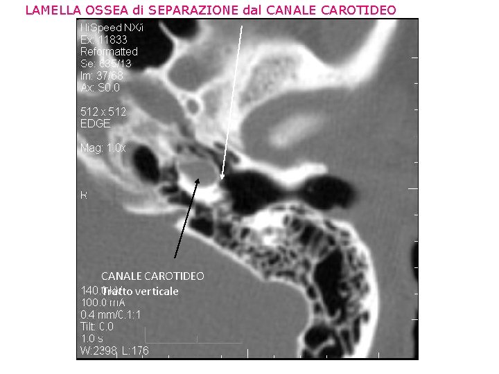 LAMELLA OSSEA di SEPARAZIONE dal CANALE CAROTIDEO Tratto verticale 