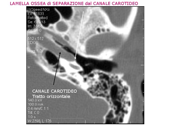 LAMELLA OSSEA di SEPARAZIONE dal CANALE CAROTIDEO Tratto orizzontale 