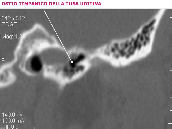 OSTIO TIMPANICO DELLA TUBA UDITIVA 