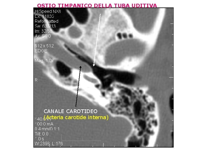 OSTIO TIMPANICO DELLA TUBA UDITIVA CANALE CAROTIDEO (Arteria carotide interna) 