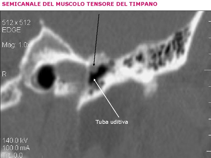 SEMICANALE DEL MUSCOLO TENSORE DEL TIMPANO Tuba uditiva 