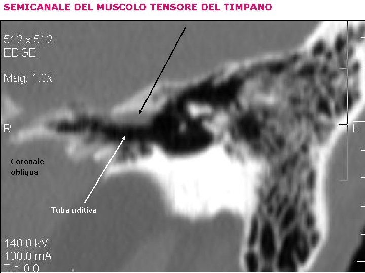 SEMICANALE DEL MUSCOLO TENSORE DEL TIMPANO Coronale obliqua Tuba uditiva 