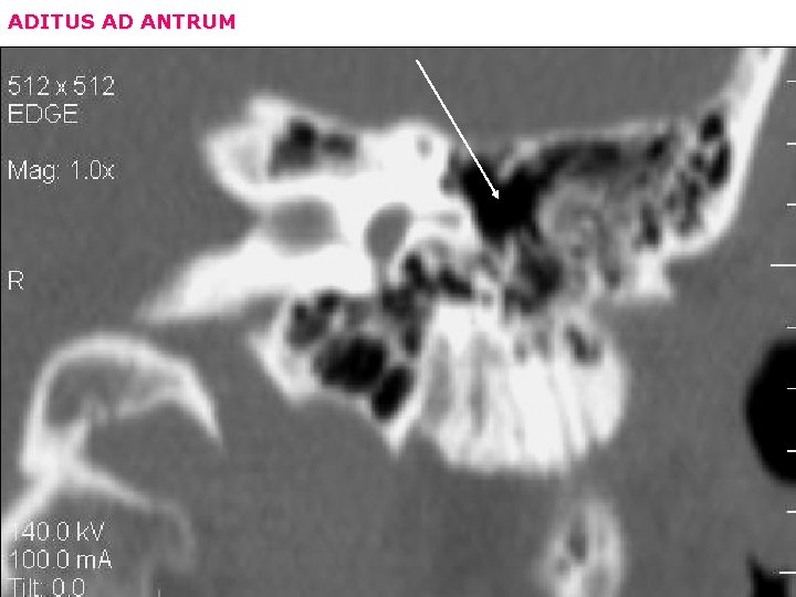 ADITUS AD ANTRUM 