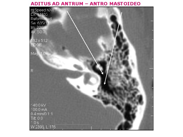 ADITUS AD ANTRUM – ANTRO MASTOIDEO 