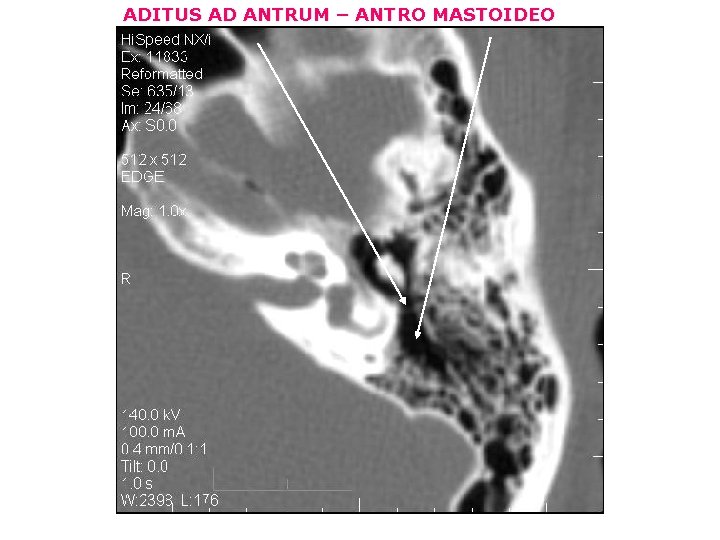 ADITUS AD ANTRUM – ANTRO MASTOIDEO 