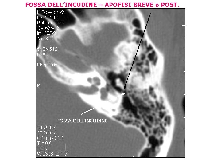 FOSSA DELL’INCUDINE – APOFISI BREVE o POST. FOSSA DELL’INCUDINE 