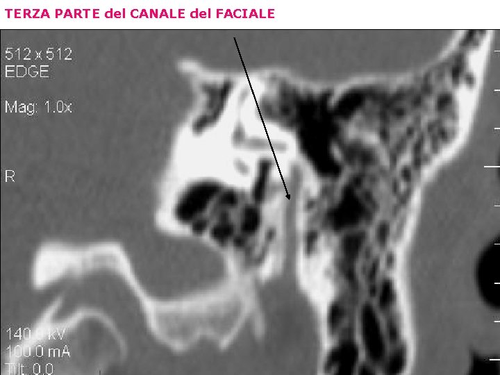 TERZA PARTE del CANALE del FACIALE 