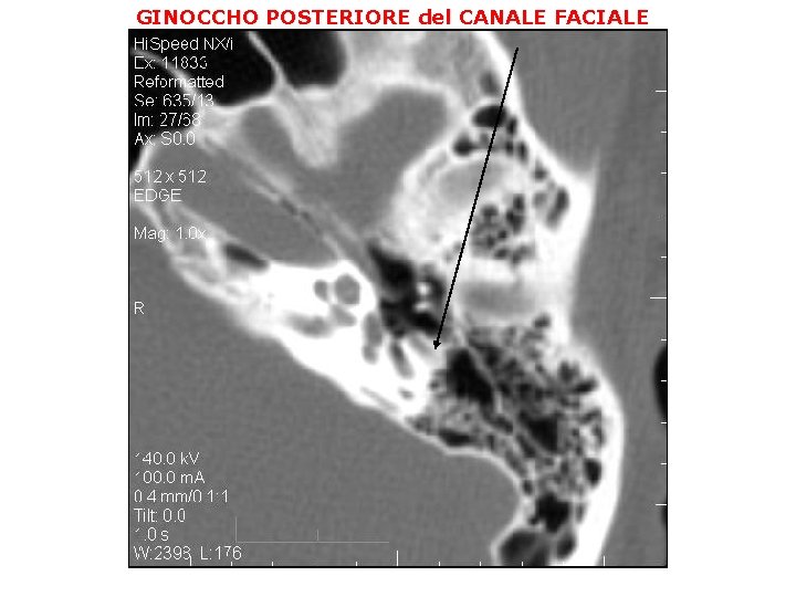 GINOCCHO POSTERIORE del CANALE FACIALE 