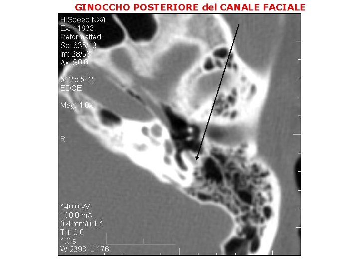 GINOCCHO POSTERIORE del CANALE FACIALE 