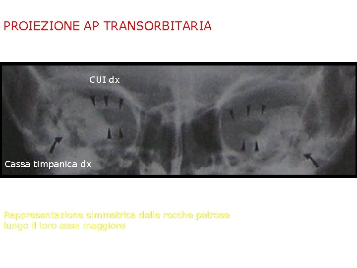 PROIEZIONE AP TRANSORBITARIA CUI dx Cassa timpanica dx Rappresentazione simmetrica delle rocche petrose lungo