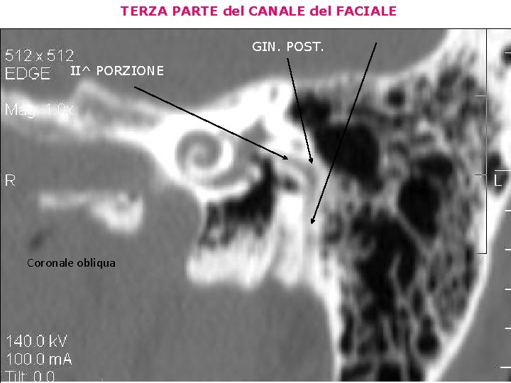 TERZA PARTE del CANALE del FACIALE GIN. POST. II^ PORZIONE Coronale obliqua 