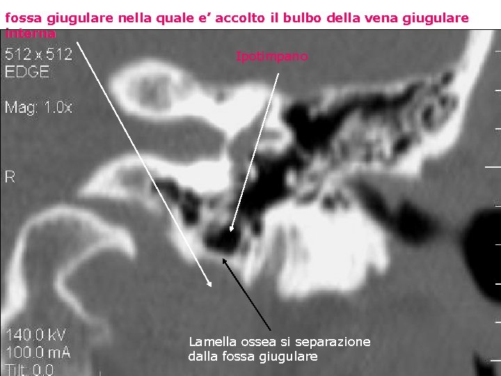 fossa giugulare nella quale e’ accolto il bulbo della vena giugulare interna Ipotimpano Lamella