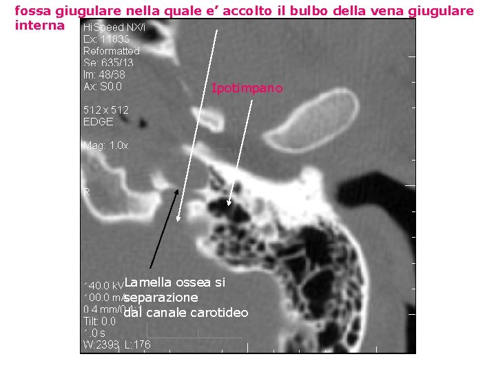 fossa giugulare nella quale e’ accolto il bulbo della vena giugulare interna Ipotimpano Lamella