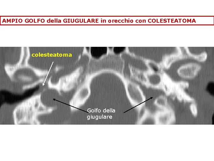 AMPIO GOLFO della GIUGULARE in orecchio con COLESTEATOMA colesteatoma Golfo della giugulare 