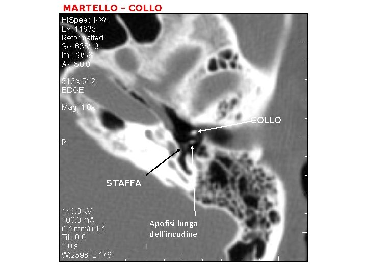 MARTELLO - COLLO STAFFA Apofisi lunga dell’incudine 