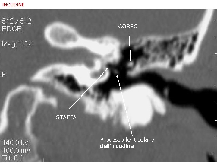 INCUDINE CORPO STAFFA Processo lenticolare dell’incudine 