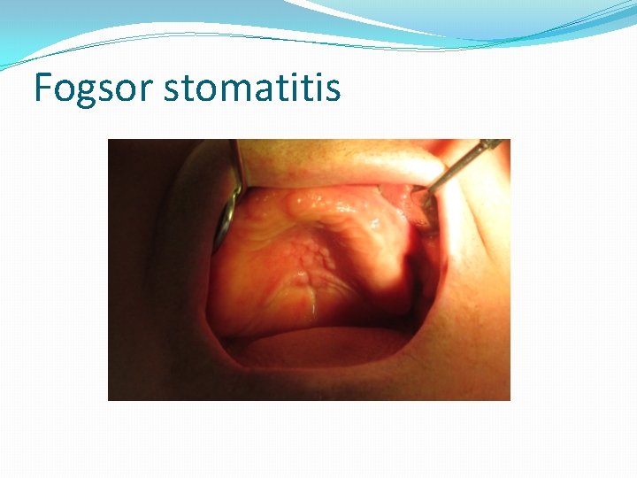 stomatitis diabétesz kezelésében