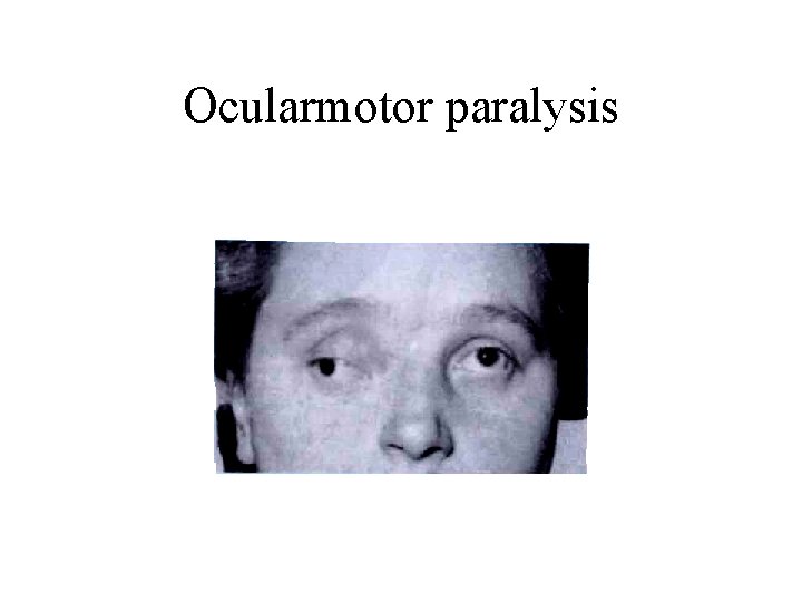 Ocularmotor paralysis 