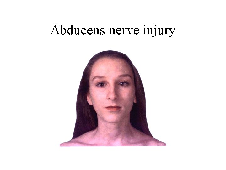 Abducens nerve injury 
