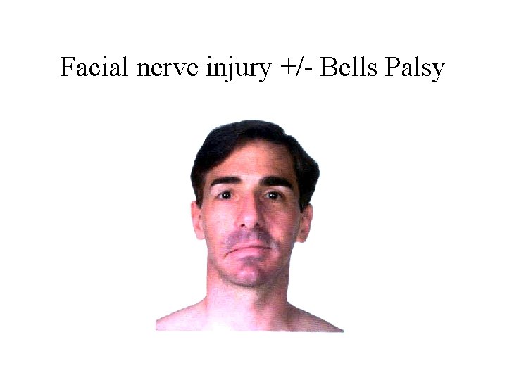 Facial nerve injury +/- Bells Palsy 
