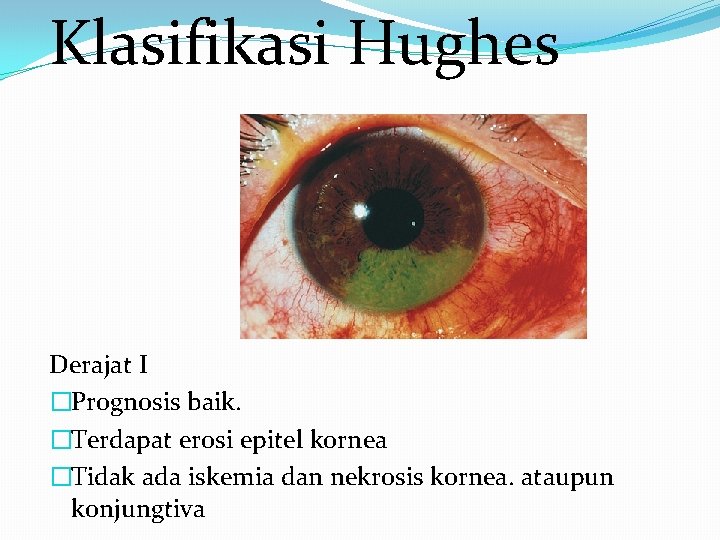 Klasifikasi Hughes Derajat I �Prognosis baik. �Terdapat erosi epitel kornea �Tidak ada iskemia dan