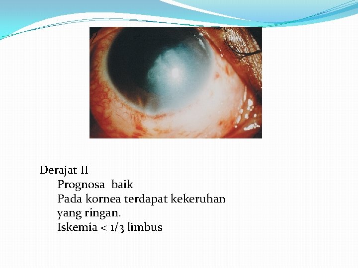 Derajat II Prognosa baik Pada kornea terdapat kekeruhan yang ringan. Iskemia < 1/3 limbus